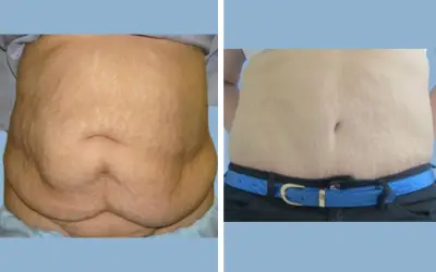 Before and After